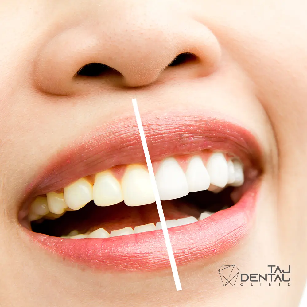جرم گیری و بروساژ اقدسیه