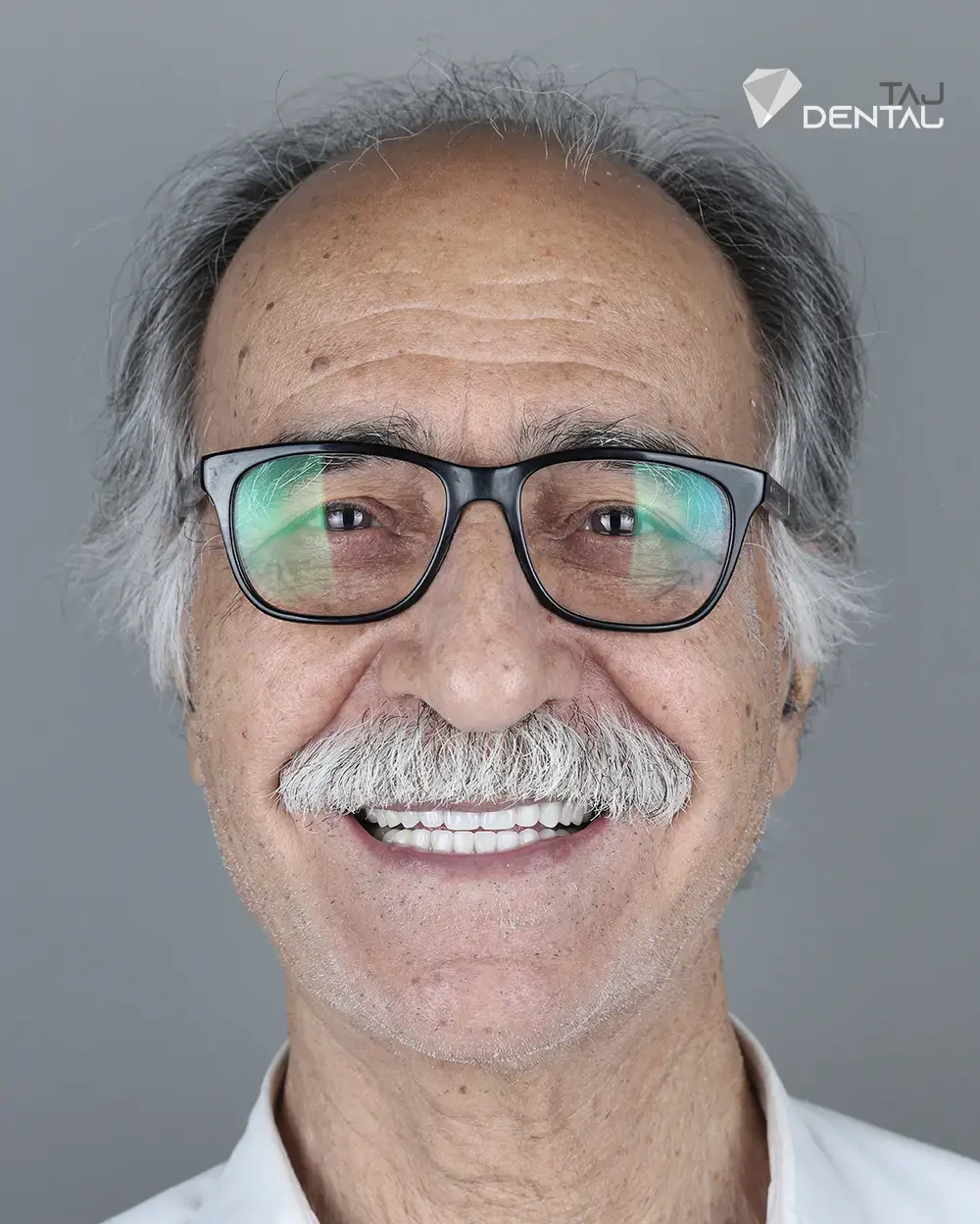 نمونه کار ایمپلنت دندان - کلینیک دکتر تاجیک