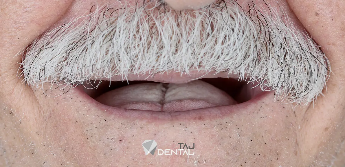 نمونه کار ایمپلنت دندان - کلینیک دکتر تاجیک