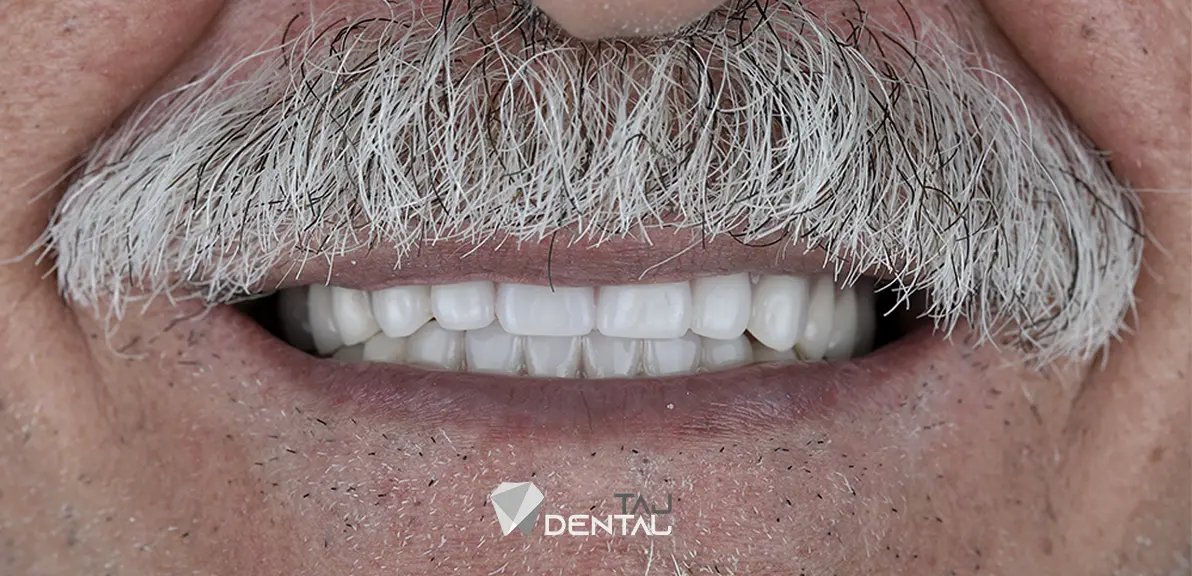 نمونه کار ایمپلنت دندان - کلینیک دکتر تاجیک