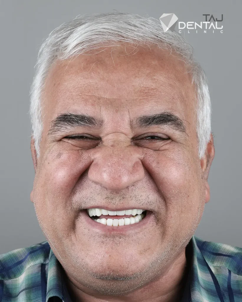 نمونه کار ایمپلنت و لمینت