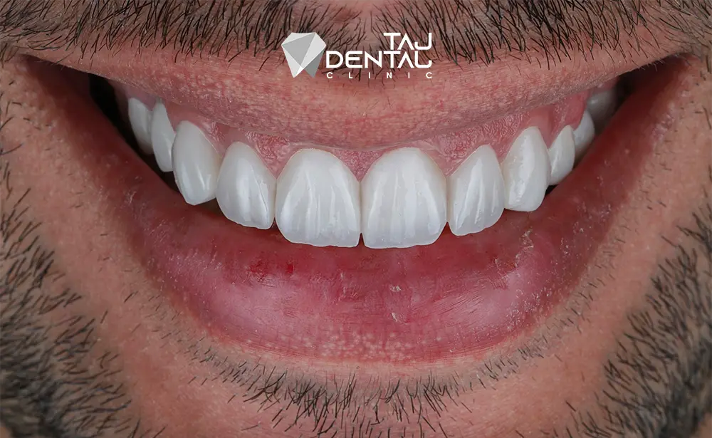 نمونه کار لمینت دندان قبل و بعد نمونه کار لمینت دندان قبل و بعد