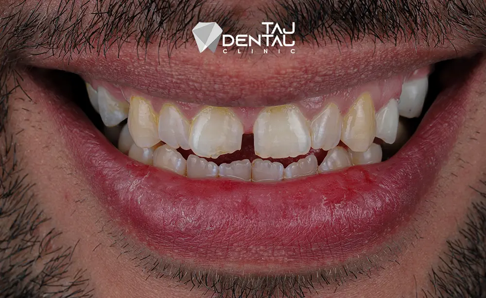 نمونه کار لمینت دندان قبل و بعد نمونه کار لمینت دندان قبل و بعد