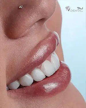 لمینت دندان در ارتش