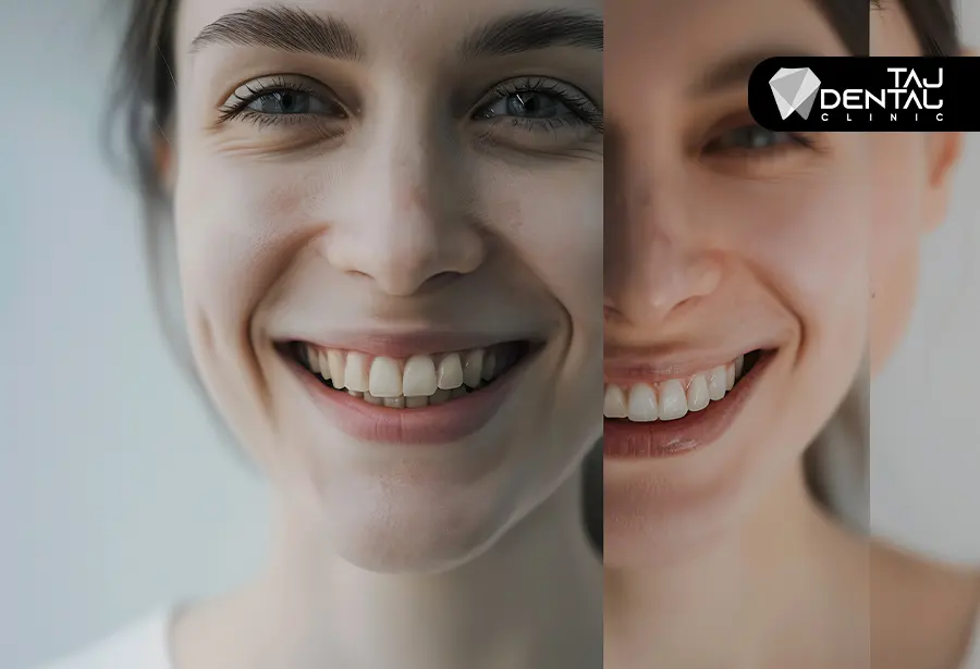 لمینت یا کامپوزیت؟