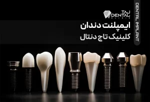 ایپلنت دندان