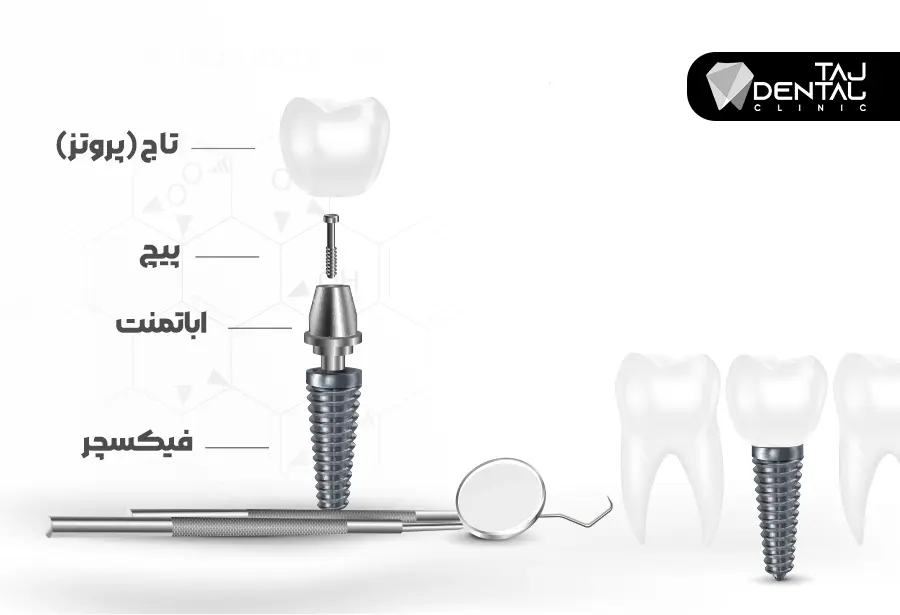 اجزای ایمپلنت دندان
