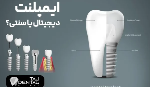 ایمپلنت دیجیتال یا سنتی