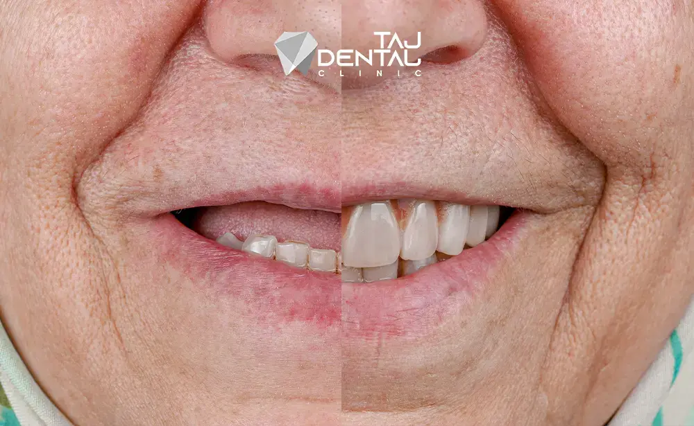 قیمت ایمپلنت دندان