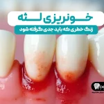 خونریزی لثه