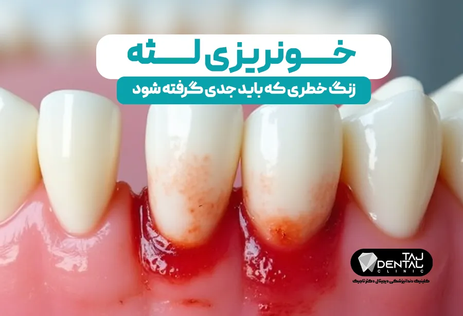 خونریزی لثه