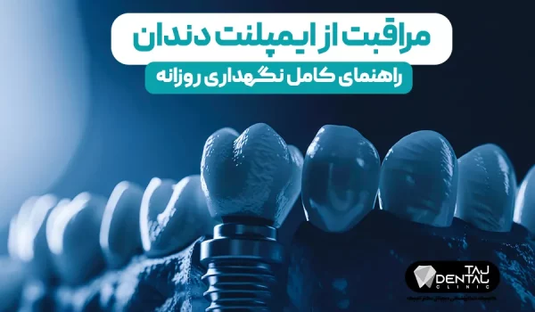 مراقبت از ایمپلنت دندان