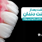 نگهداری از لمینت دندان