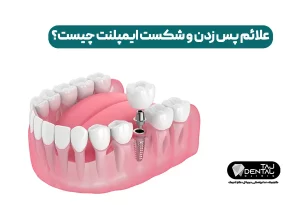 شکست ایمپلنت